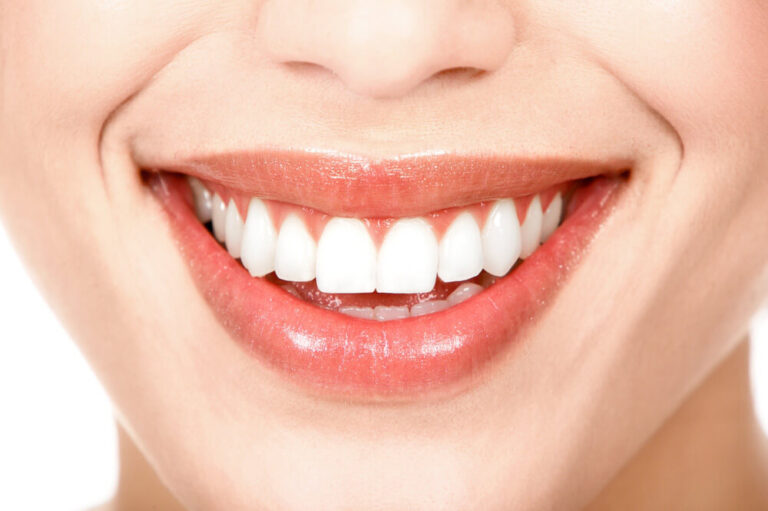 Todo lo que debes saber sobre las Carillas Dentales