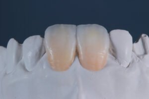 Técnicas de estratificación para lograr restauraciones dentales más estéticas